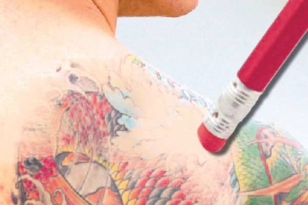 tattoo removal